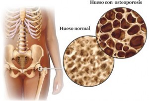 osteoporosis1