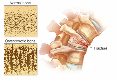 Fractura vertebral osteoporosis