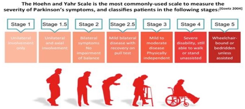 parkinson figura 1 - Caso real: Efectos del método Pilates sobre una persona con Parkinson